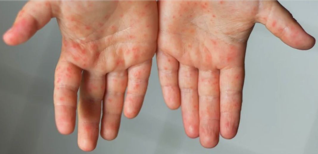 Alerta OMS y CDC de una “amenaza inminente por sarampión” tras casos de Covid-19