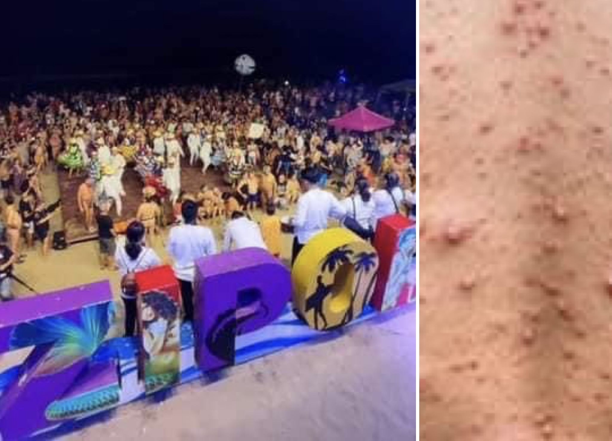 Aumentan a cinco los casos de mpox o viruela símica detectados en Oaxaca y la CDMX; contagios, en Zipolite