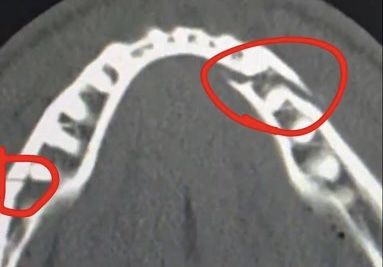 Anthony Joshua le causó doble fractura mandibular a Jake Paul durante la pelea de seis rounds y el nocaut en Miami Anthony Joshua le causó doble fractura mandibular a Jake Paul durante la pelea de seis rounds y el nocaut en Miami