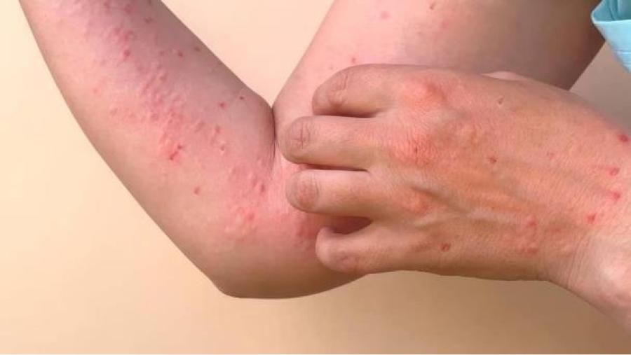 Oaxaca confirma primer fallecido por dengue en 2026: se trata de un niño de 6 años, en Salina Cruz