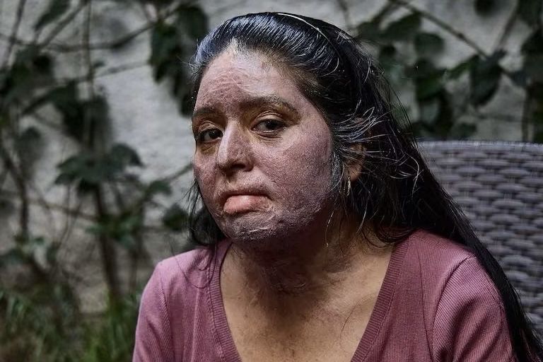 CEAIV niega registro como víctima a sobreviviente de ataque con gasolina que mató a sus dos hijas