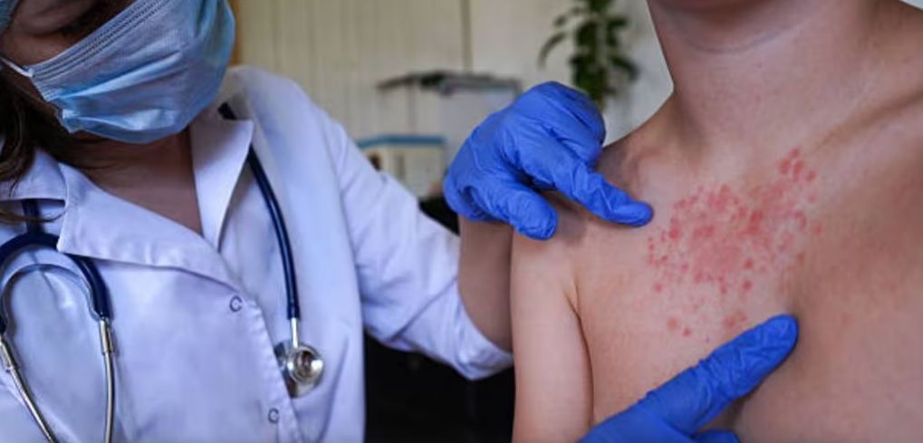 EU reporta sus primeras muertes por sarampión en 35 años; fallecimientos ocurren en Pensilvania